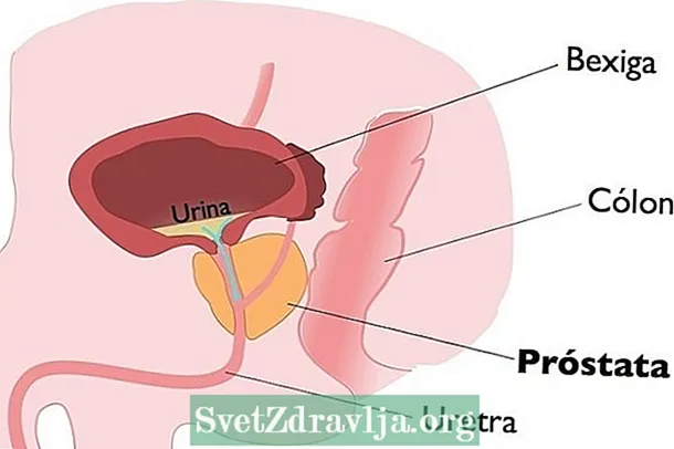 Vergréissert Prostata: Ursaachen, Symptomer a Behandlung