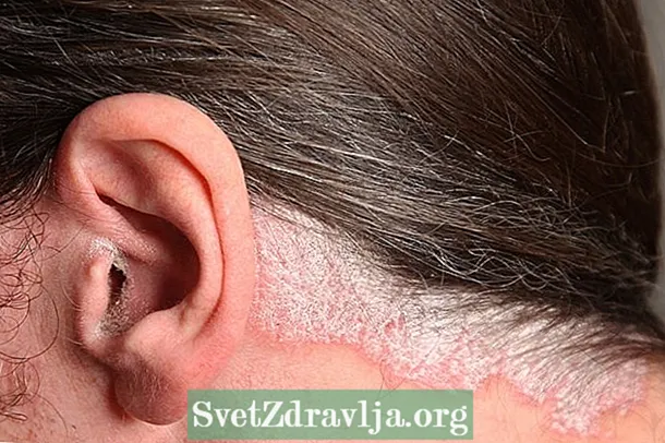 Luskavica lasišča: kaj je to in glavni načini zdravljenja