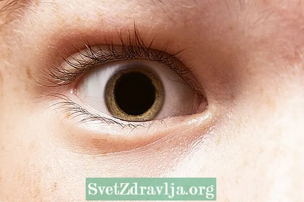 Tágult pupillák: 7 fő ok és súlyos állapot