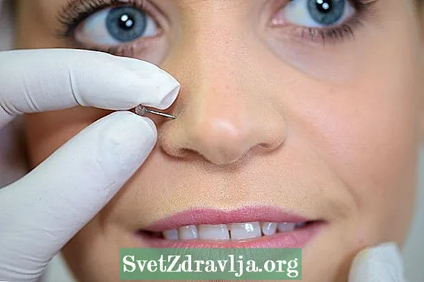 Ποια είναι η θεραπεία για το χηλοειδές στη μύτη και πώς να αποφύγετε - Καταλληλότητα
