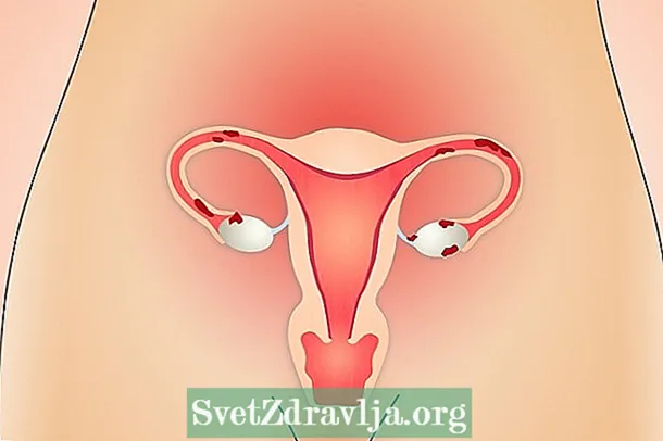 Kellel on endometrioos, võib rasestuda?