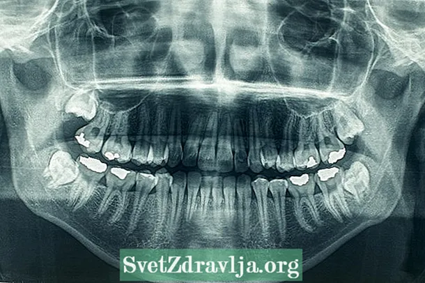 Panorama parola rentgenradio (Ortopantomografio): por kio ĝi utilas kaj kiel ĝi fariĝas? - Sano