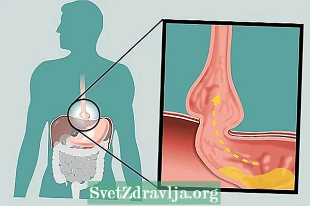 胃食道逆流症：それが何であるか、症状と治療