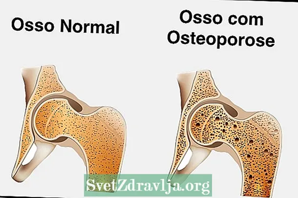 Osteoporoosin korjaustoimenpiteet