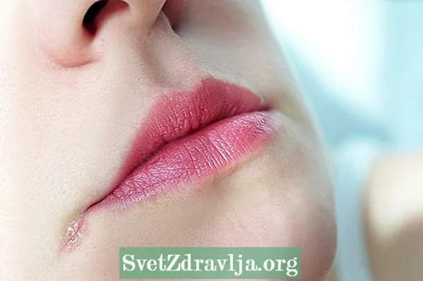 Lijekovi za liječenje čireva u kutu usta (usnik)