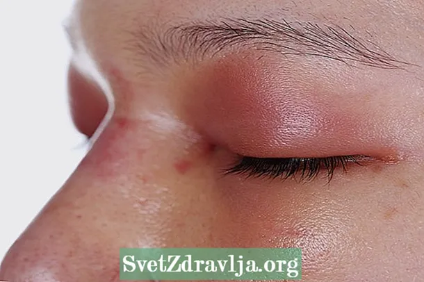 Rosacea çav: çi ye, nîşan û dermankirin