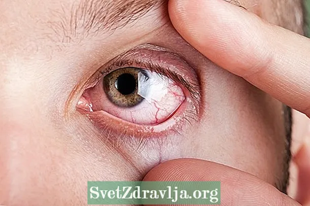 Дали знаевте дека ревматоидниот артритис може да влијае на очите?
