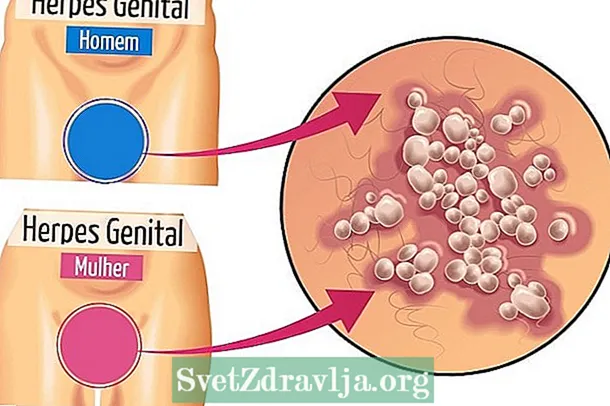 Naučte se, jak rozpoznat příznaky herpesu - Zdatnost