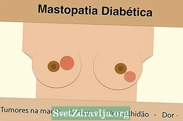 Muta otu esi emeso Mastopathy Diabetic - Ahụ Ike