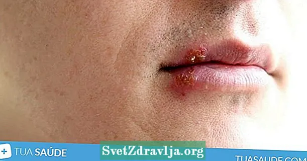 Conegueu els símptomes i com tractar l’herpes labial