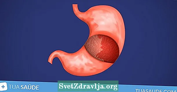 Sib x'inhuma s-sintomi u t-trattament tal-Gastrite Nervuża