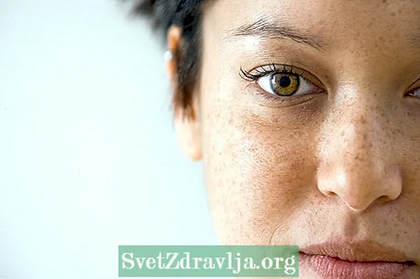 Freckles: zvavari uye maitiro ekuvatora