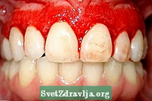 Tegn og symptomer på tannkjøttbetennelse