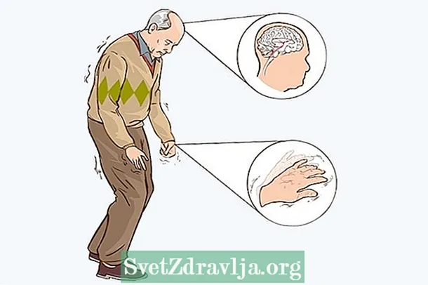 Parkinsons tegn og symptomer