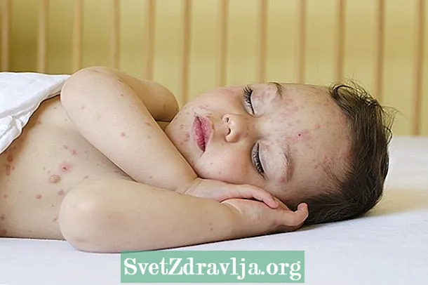 婴儿水痘的症状，传播及如何治疗