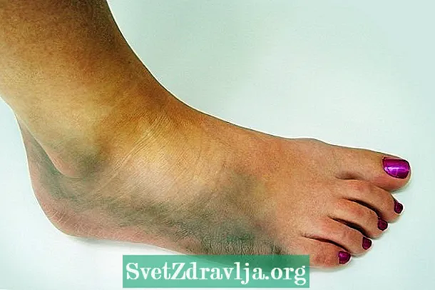 Sintomi dell'entrosi della caviglia e come è il trattamento