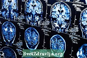 Тархи ба бамбай булчирхайд коллоид цистийн шинж тэмдэг ба эмчилгээ - Эрүүл Мэнд