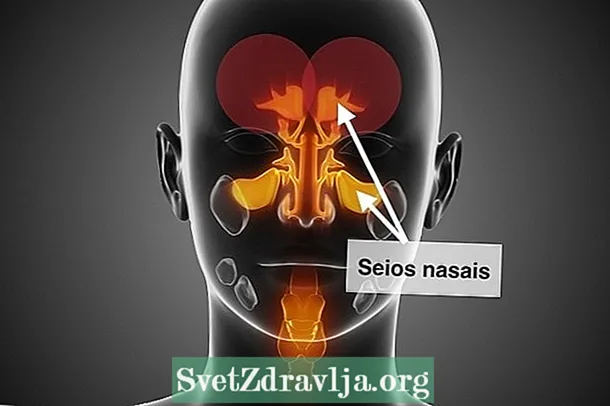 Sinusopathia: mi ez, tünetek és kezelés - Alkalmasság