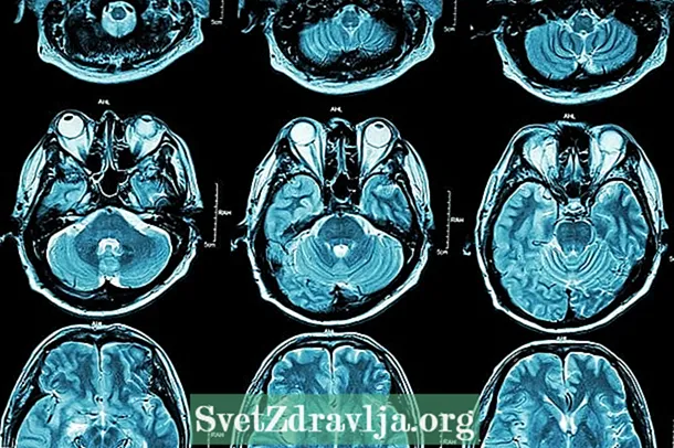Arnold-Chiari sindrom: što je to, vrste, simptomi i liječenje