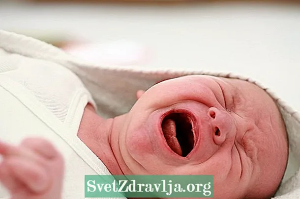 Sindromo de skuita bebo: kio ĝi estas, simptomoj kaj kion fari