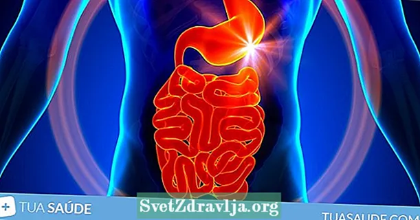 Irritable bowel syndrome: ano ito, sintomas at paggamot
