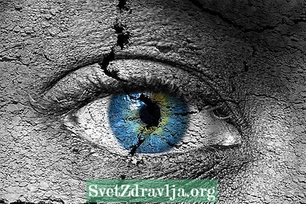 Quru göz sindromu: nədir, simptomları və müalicəsi