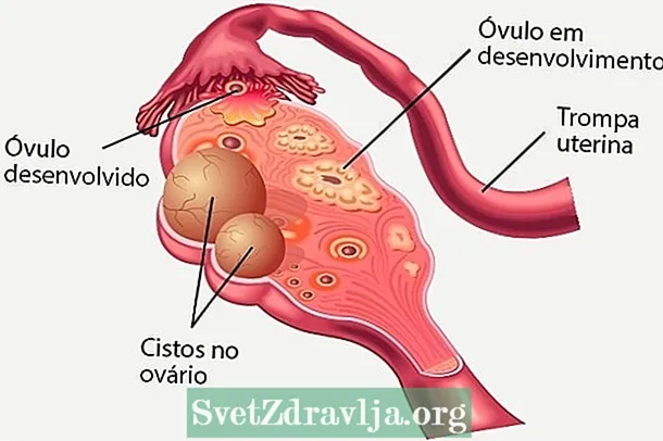 Syndrome polycystic ovary: inona izany, soritr'aretina ary fitsaboana
