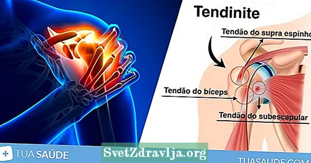 Tendonitis ramena: što je to, simptomi i liječenje