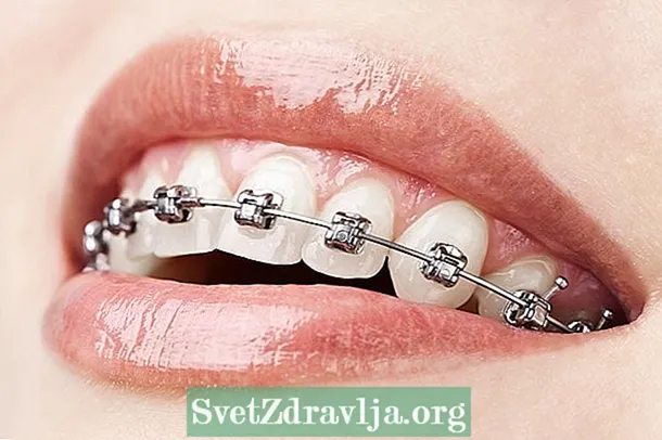 Tipi di apparecchi ortodontici è quantu aduprà - Salute