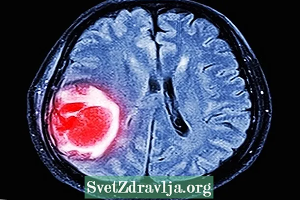 Jenis tumor otak, pengobatan dan kemungkinan gejala sisa