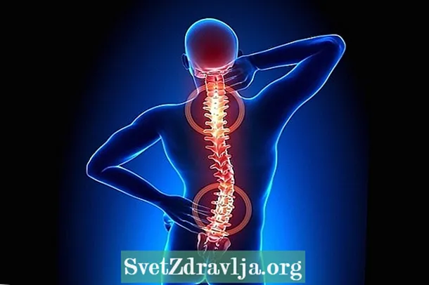 Pagtambal alang sa spinal arthrosis - Panglawas
