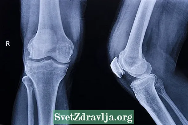 Trattamento per l'artrosi del ginocchio