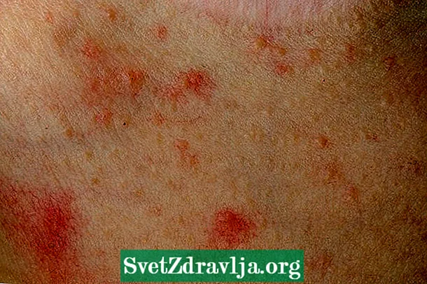 Atopic dermatitis لاءِ علاج
