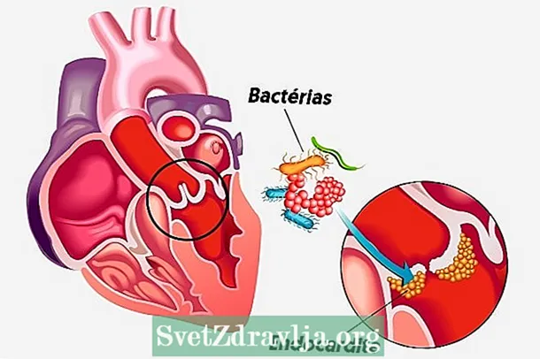 Behandeling voor bacteriële endocarditis