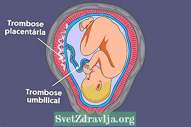 Placental uye umbilical thrombosis: zvavari, zviratidzo uye kurapwa