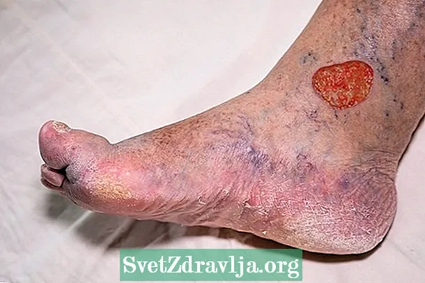Ulcer varicose: çi ye, sedemên sereke û dermankirin