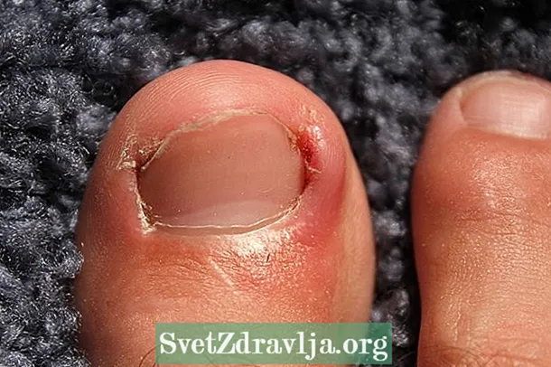 Болни нокти: како се негују и лече