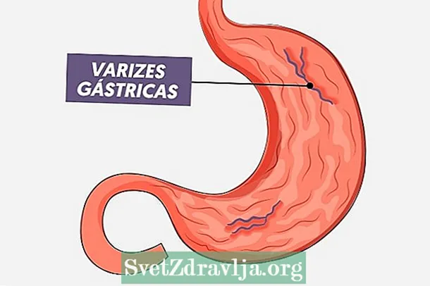 Проширени вени во стомакот: какви се тие, причини и третман