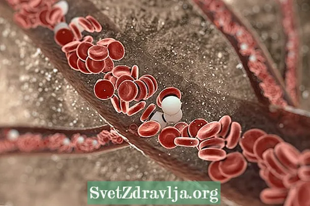 Krčne žile medenice: kaj so, simptomi in zdravljenje