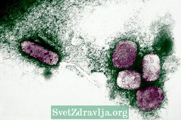 Smallpox: unsa kini, mga simtomas ug pagtambal