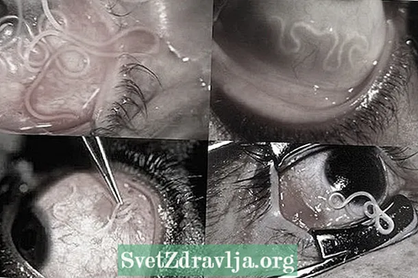 Vierme în ochi: ce este, principalele cauze și tratament