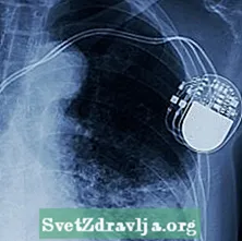 Herzschrittmacher und implantierbare Defibrillatoren