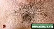 Павелічэнне грудзей у мужчын (гинекомастия)
