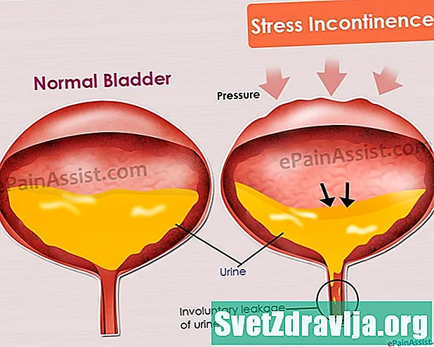 Stressz-inkontinencia