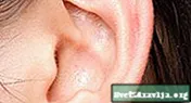 Què causa la descàrrega de l'oïda i com puc tractar-la? - Benestar