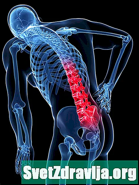 Što je bol u leđima?